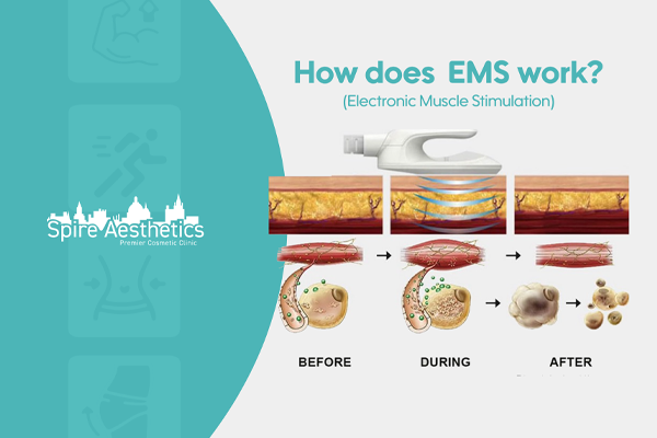 EMS treatment for post pregnancy weight loss treatment Didcot