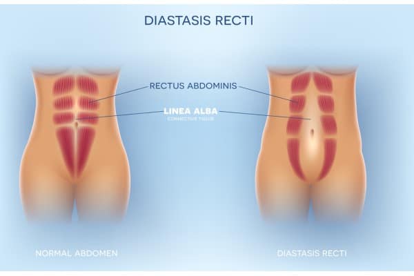 What Non-Surgical Options Are Available for Diastasis Recti Didcot?