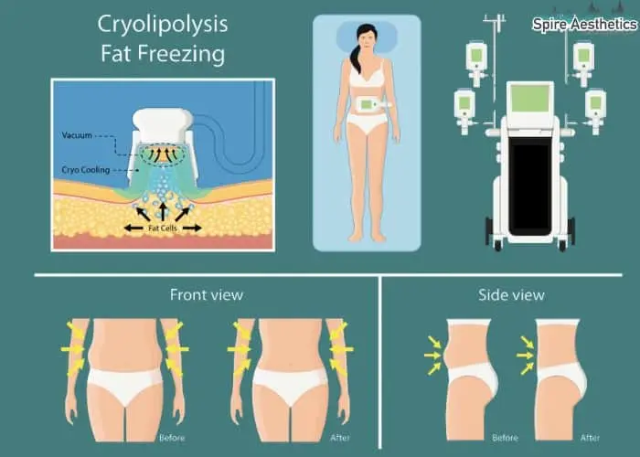Fat freezing treatment Didcot benefits for competitions to remove stubborn fat deposits.
