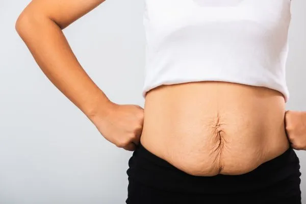 Image of a woman's stomach after weight loss with sagging skin following a gastric band Didcot