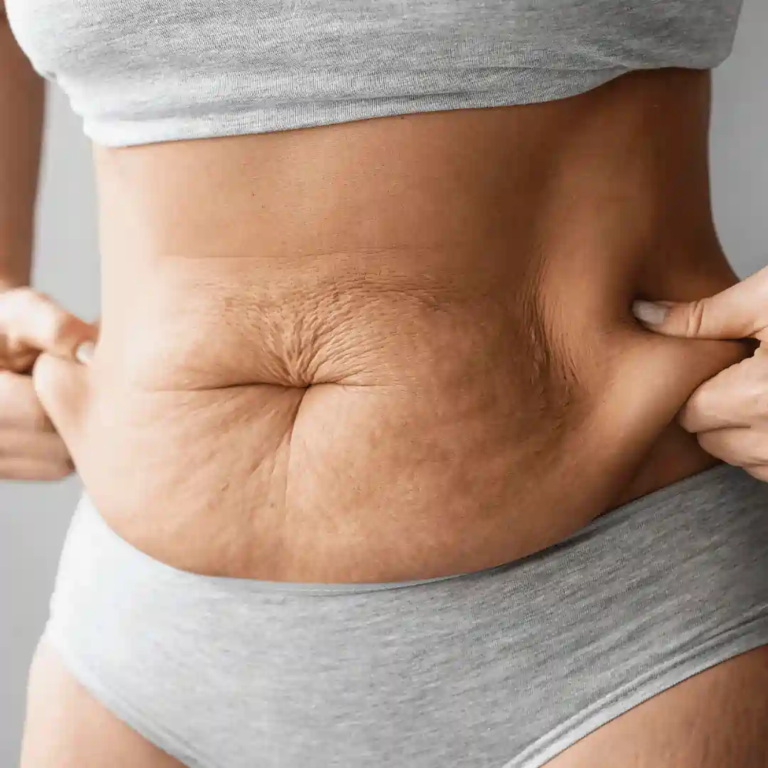 Is It Normal to Have Loose Skin After Pregnancy Didcot?