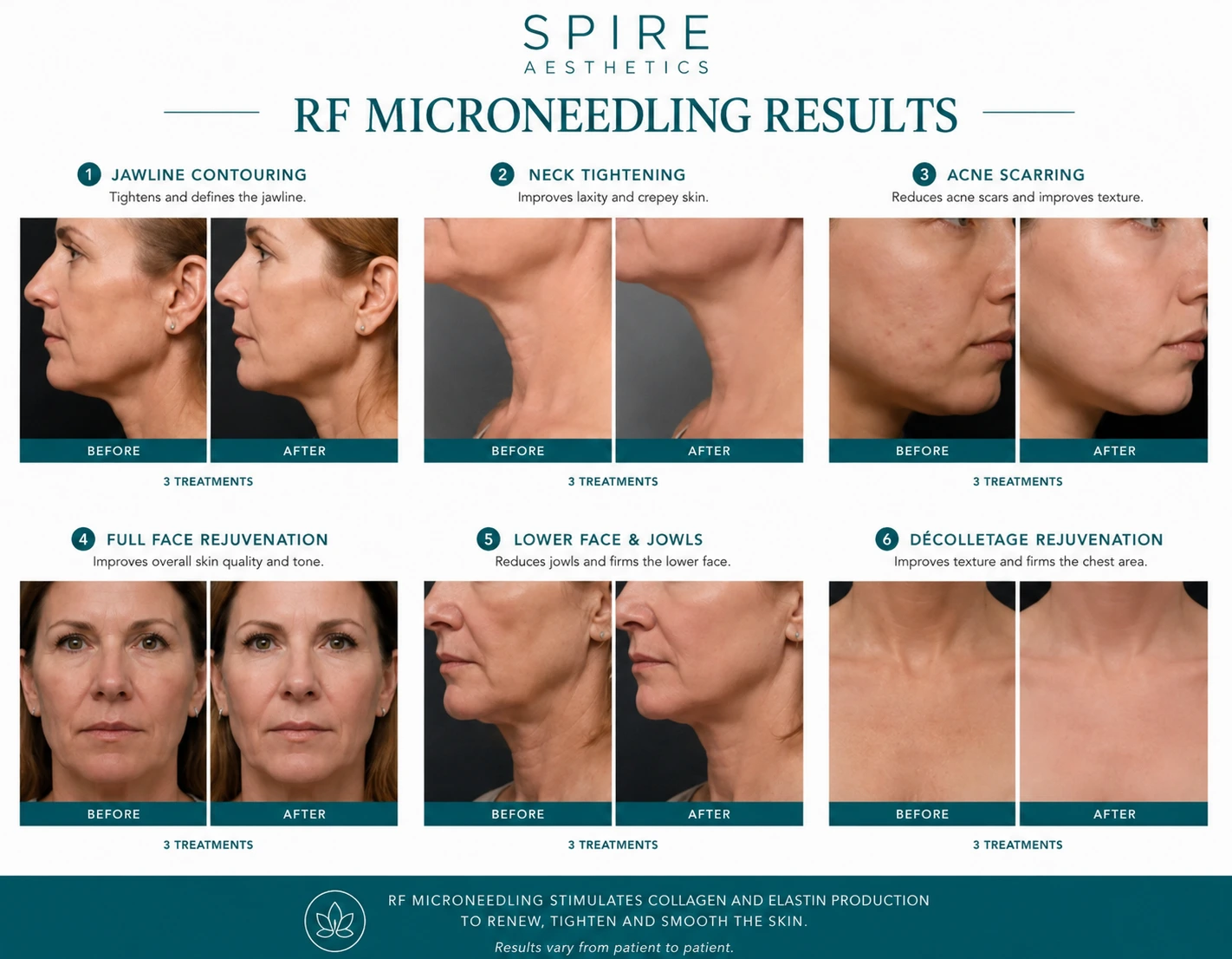 RF Microneedling Skin tightening Didcot results