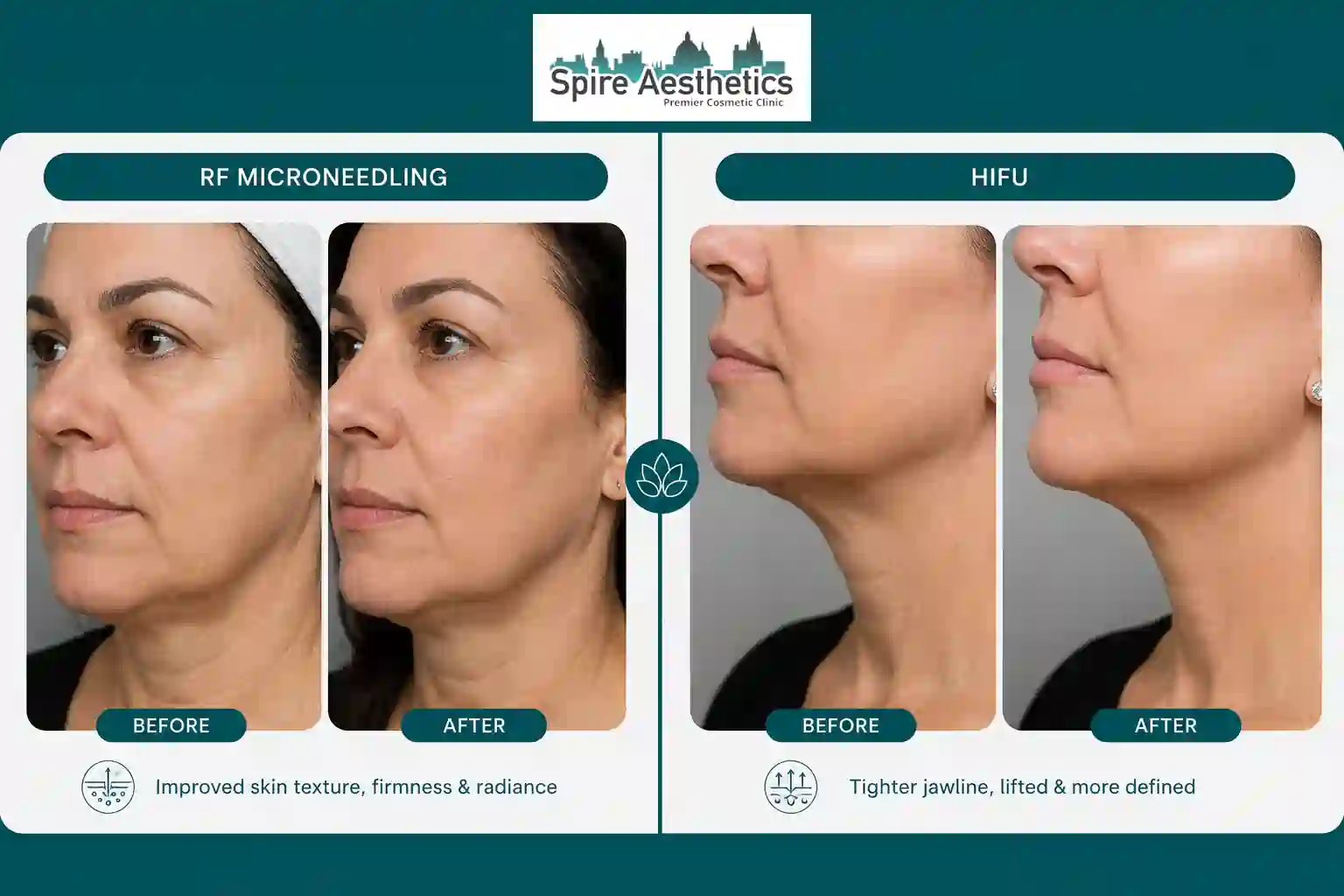 Can RF Microneedling and HIFU Be Combined Didcot?