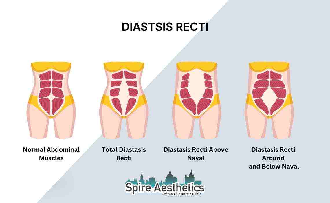 Is Non-Surgical Diastasis Recti Treatment Right for You? Common Concerns Answered Didcot